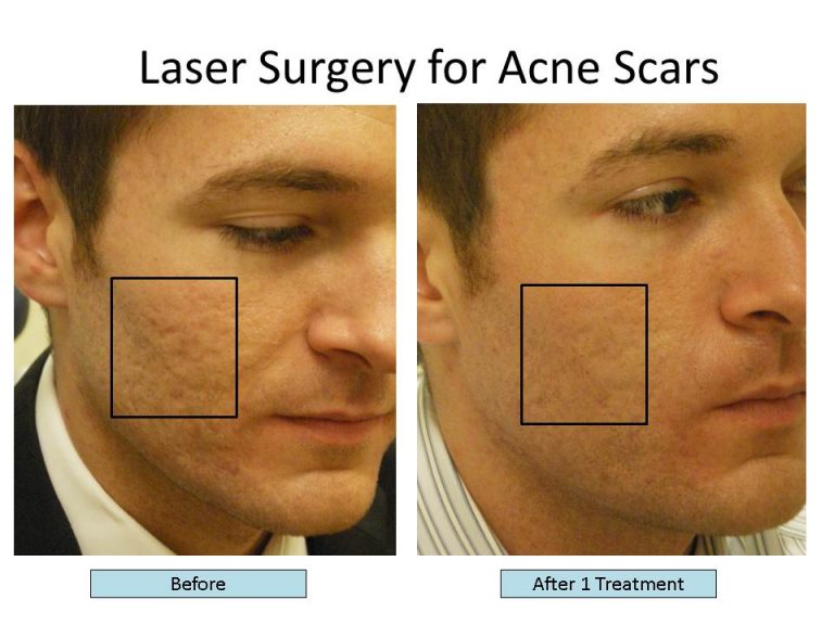 Fractional CO2 Lasers - Dermesthetic Clinic