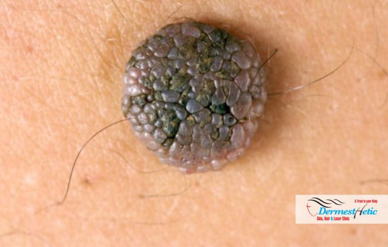 Epidermal Nevus Syndrome (ENS) - Dermesthetic Clinic